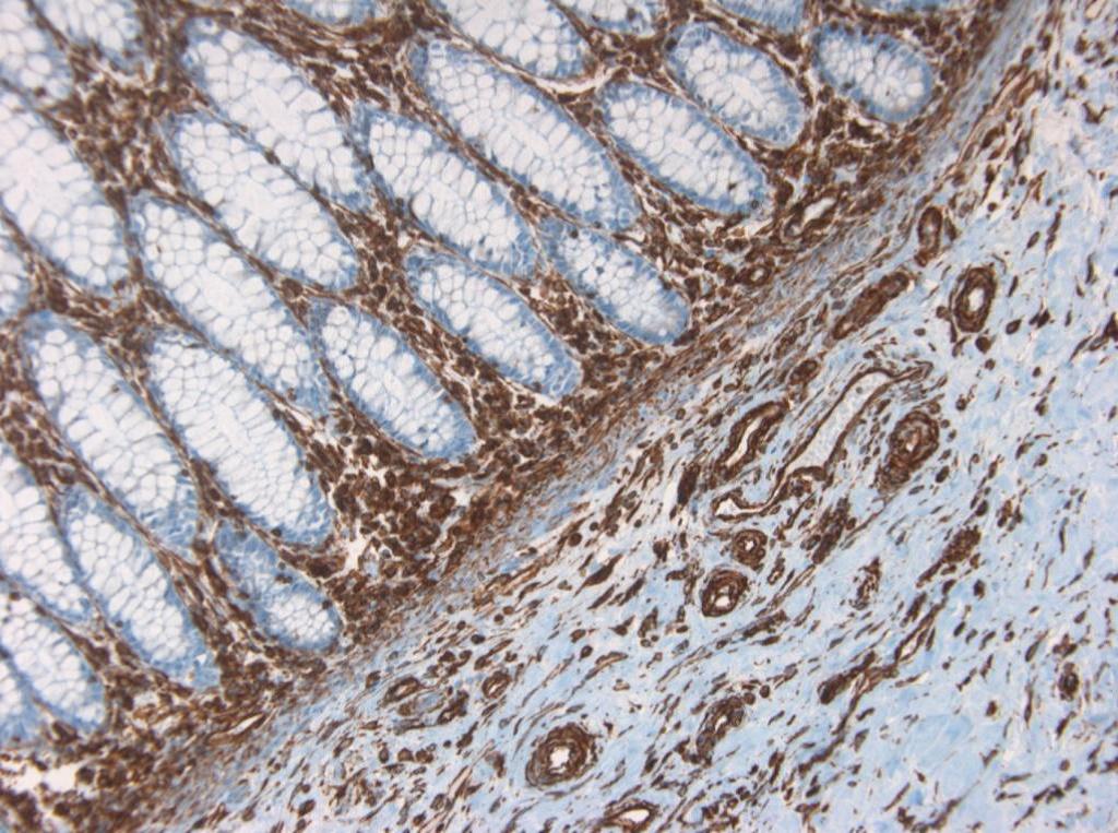 Figure 11. Immunohistochemistry on formalin fixed, paraffin embedded section of human small intestine showing positive staining in connective tissue cells and no reactivity in epithelial cells.